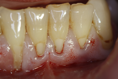 receding gums showing roots of bottom teeth