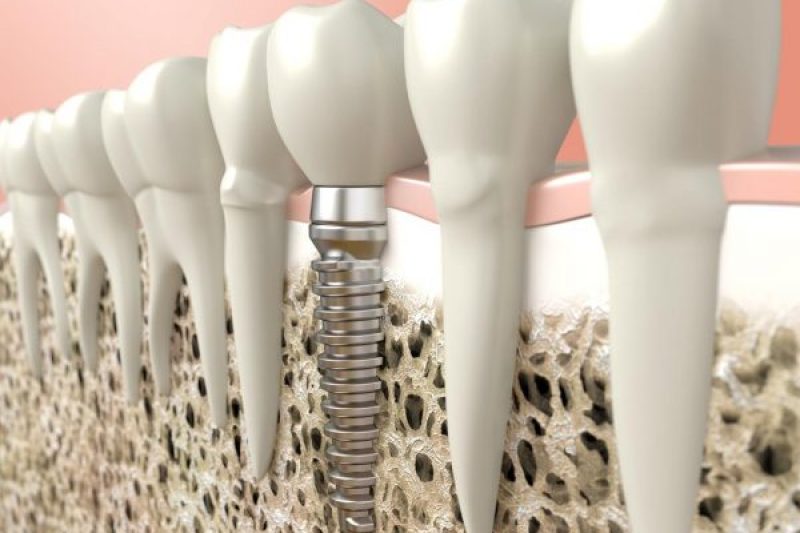 Why a bone graft is important, 3D diagram of a dental implant