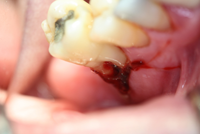 Receding gums showing root of molars