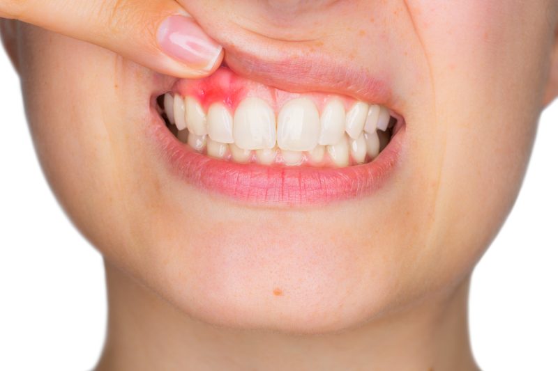 a woman with bleeding gums