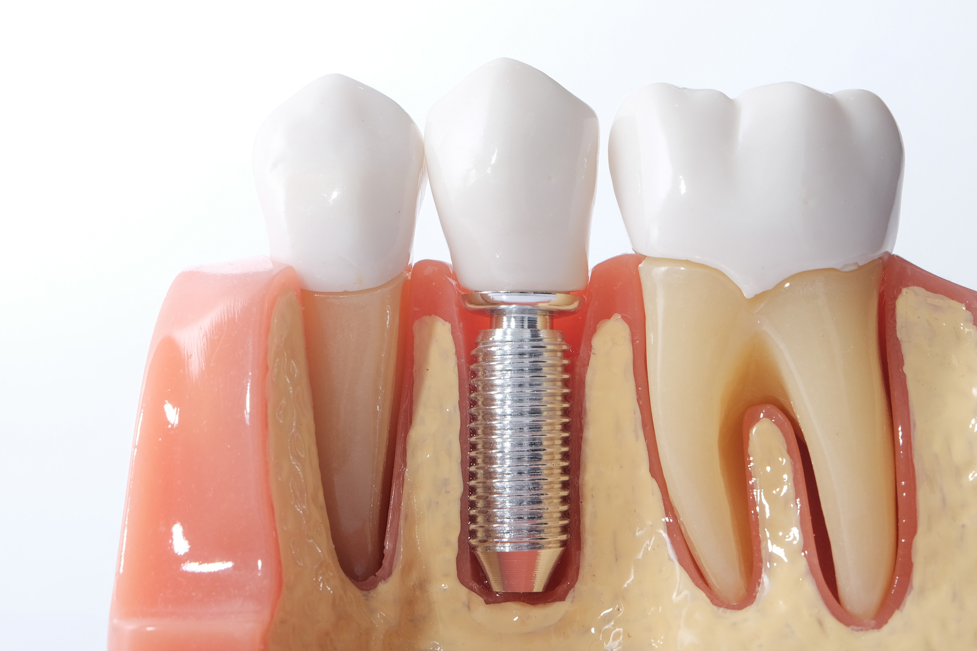 Cross section model of dental implan