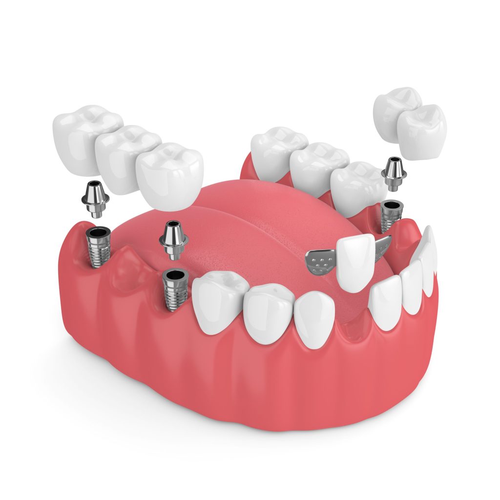 3D dental implants and dental bridges