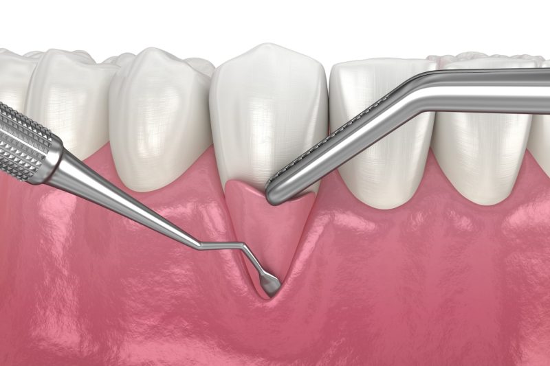 3D Rendering of a gum graft