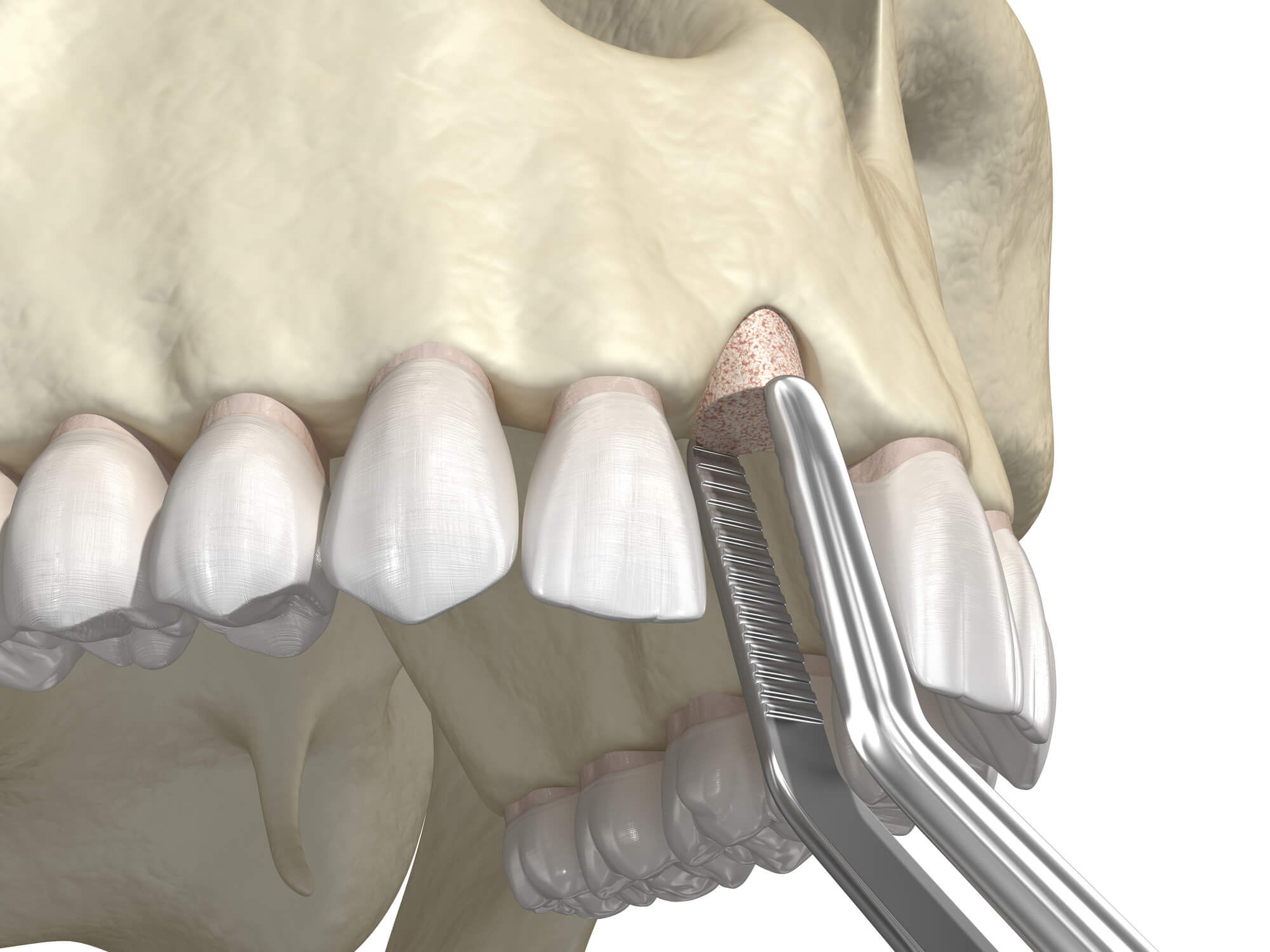 How Long Does It Take for a Dental Bone Graft to Heal? Richard