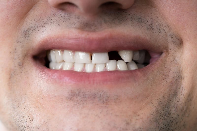 man needs to Replace missing teeth in Parkersburg